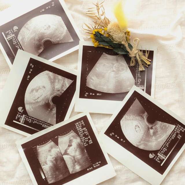 エコー写真IMAGE