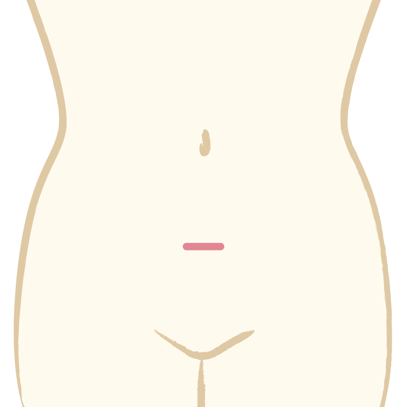 腹腔鏡手術（単孔式）