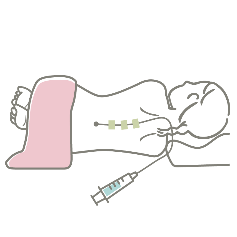 硬膜外麻酔Illust4